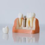 implant-dentar.jpg